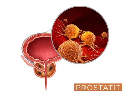 Prostatit Hastalığı Prostatit Hastalığı